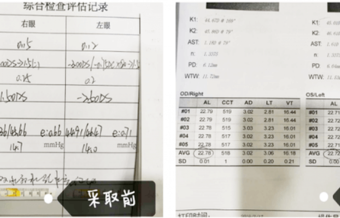 【圣爱眼科案例分享】不要等真的近视了，才后悔莫及！