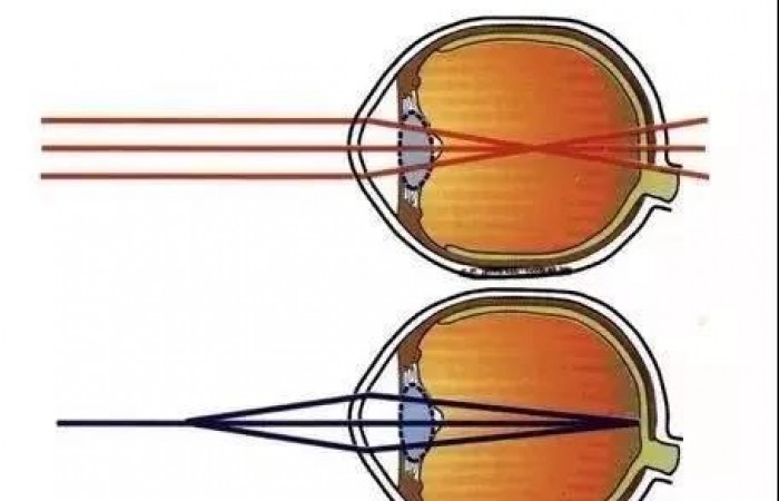 弱视家长最关心的问题（一）