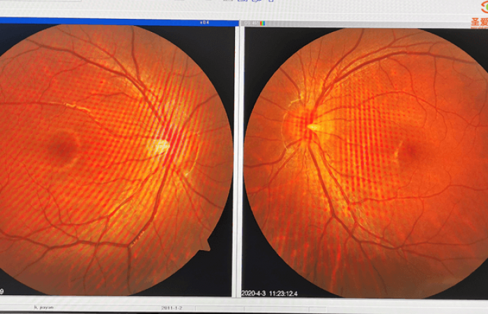 度数没涨近视就没发展？NO！